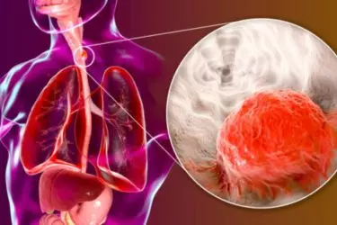 best hospital for esophageal cancer treatment in Katihar, best doctor for esophageal cancer treatment in Katihar, cost of esophageal cancer treatment in Katihar, Best Cancer Surgeon at Radiant Hospital, Best GI Cancer Surgeon in Bihar