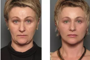 best hospital for facelift surgery in Katihar, best doctor for facelift surgery in Katihar, cost of facelift surgery in Katihar