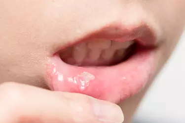 best hospital for mouth cancer treatment in Katihar, best doctor for mouth cancer treatment in Katihar, cost of mouth cancer treatment in Katihar, Dr Shahnawaz, Best Oral Cancer Surgeon, Best Oral Cancer Surgeon at Radiant Hospital, Katihar, Bihar