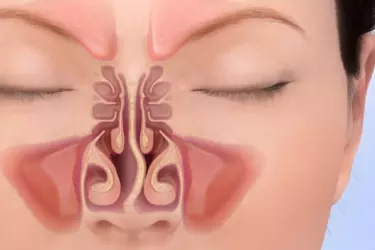 best hospital for septoplasty surgery in Katihar, best doctor for septoplasty surgery in Katihar, cost of septoplasty surgery in Katihar