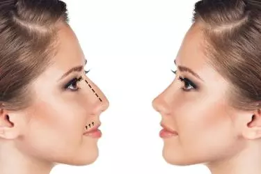 best hospital for septoplasty surgery in Katihar, best doctor for septoplasty surgery in Katihar, cost of septoplasty surgery in Katihar